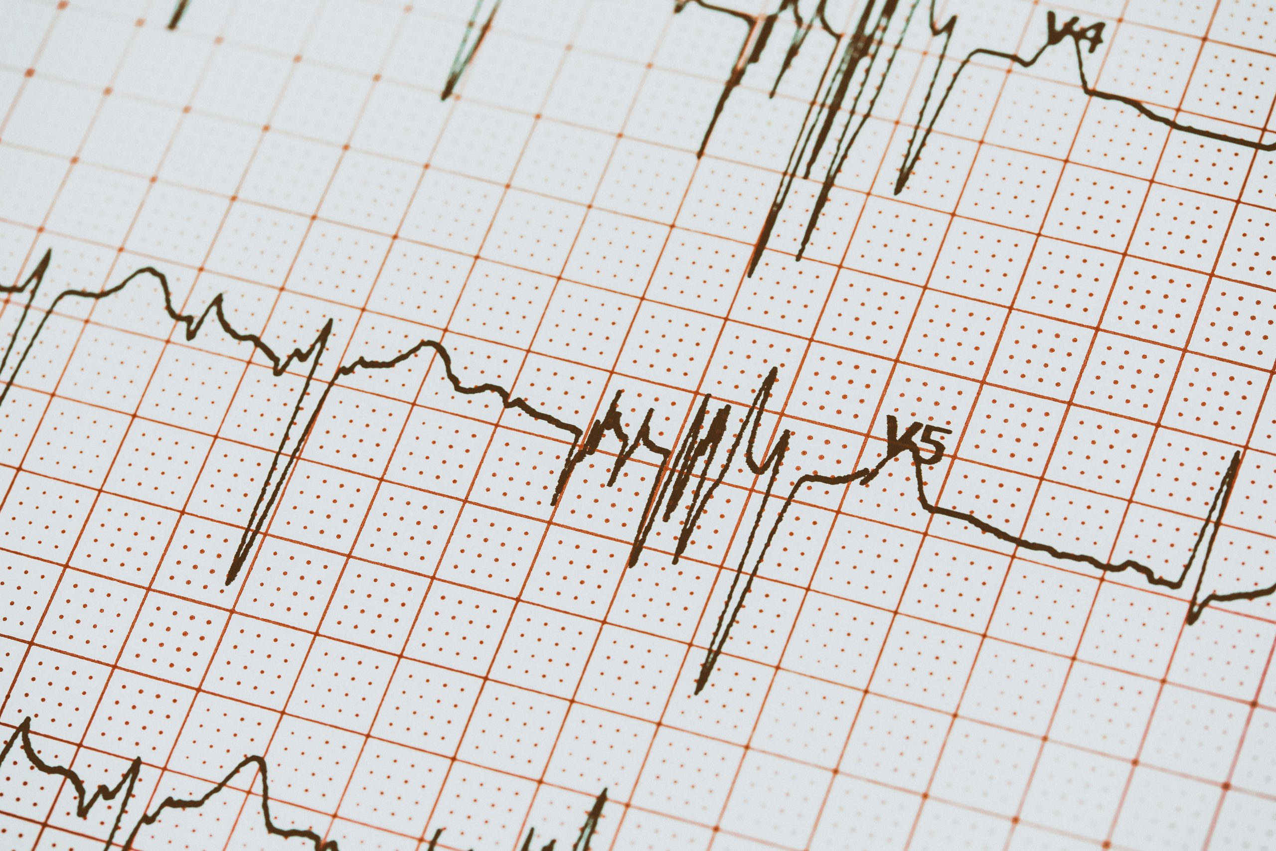 ¿Qué es un electrocardiograma?
